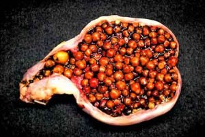 herbal menghancurkan batu empedu